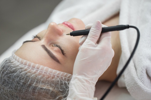 Non-Surgical Skin Tag & Mole Removal in Seaford, Brighton & East Sussex with Plasma Fibroblast