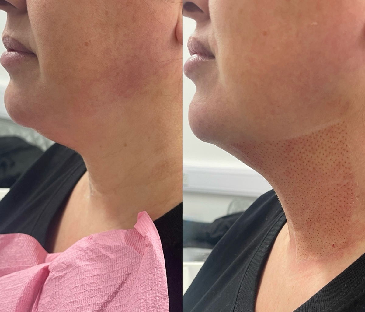Plasma Skin Tightening in Seaford, East Sussex